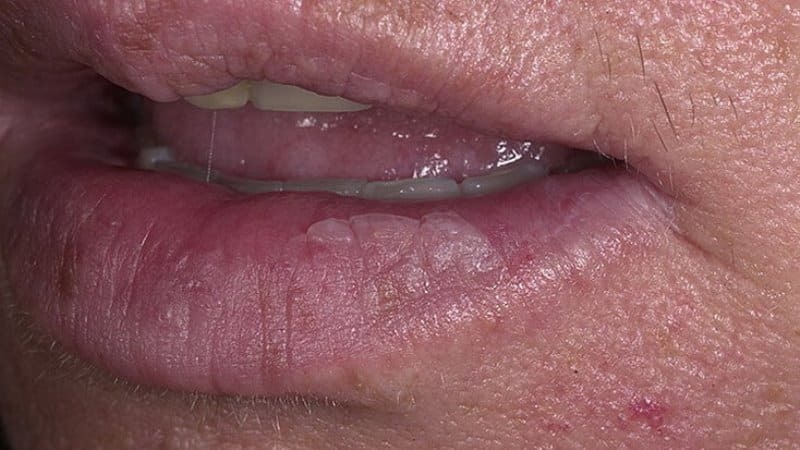 Wie zur Behandlung von Cheilitis auf den Lippen: das Foto, es ist