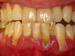 Parodontna bolest
