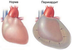 szívburokgyulladás