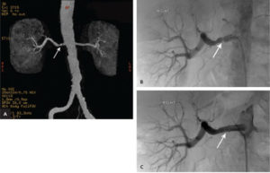 Hipertensión renal