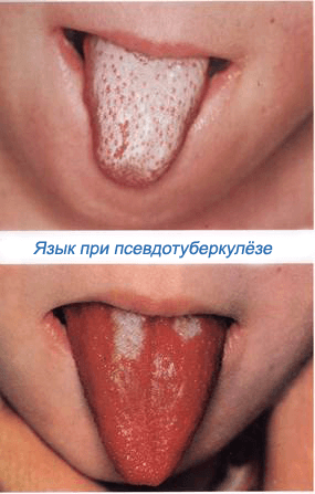 Pseudotuberculosis-crimson-tongue