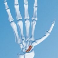 Scaphoid Osteosynthesis