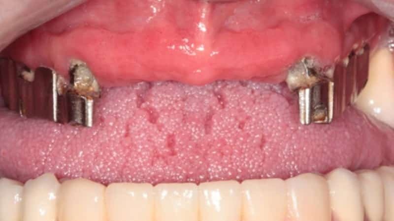 plastu pro zubní protézy