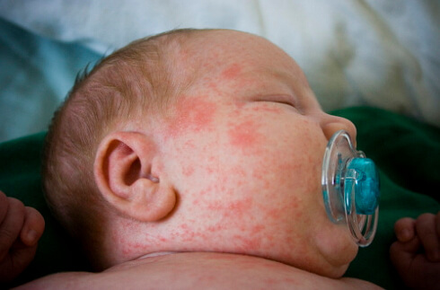 Foto alergije u novorođenčadi