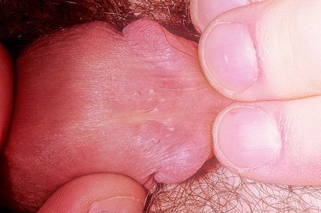 What is pearly penile papules? 