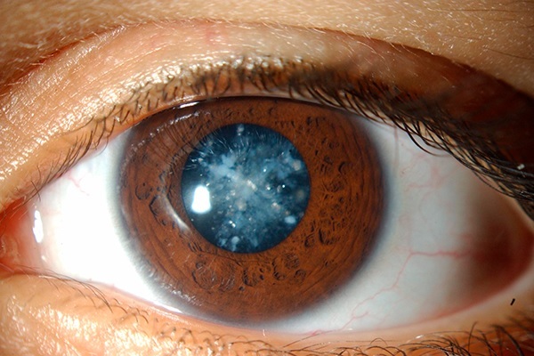 Weiße Flecken in den Augen: Müdigkeit oder Gefahrensignal?