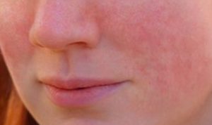 Allergie au médicament