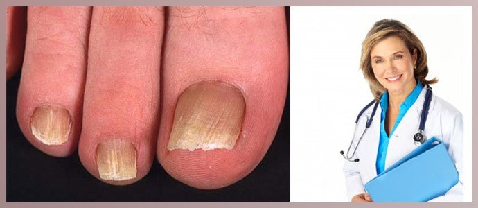 Doctor treats toenail fungus