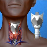 Malignant neoplasm of larynx