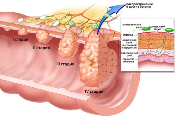 Como curar o adenocarcinoma do estômago?
