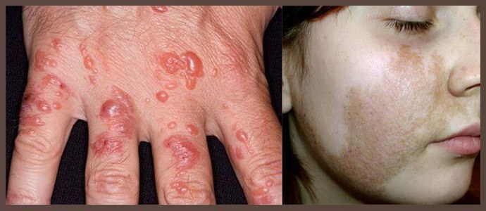 Dermatitis, Hyperpigmentierung der Haut
