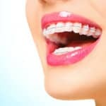 Korrigering av krökningen av tänder hos vuxna