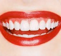 Waar is het beter om je tanden te witten - thuis of in de tandheelkunde?