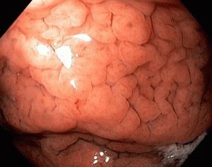 Een gevaarlijke vorm van gastritis