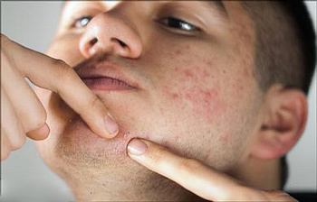 Faktorer der påvirker forekomsten af ​​acne