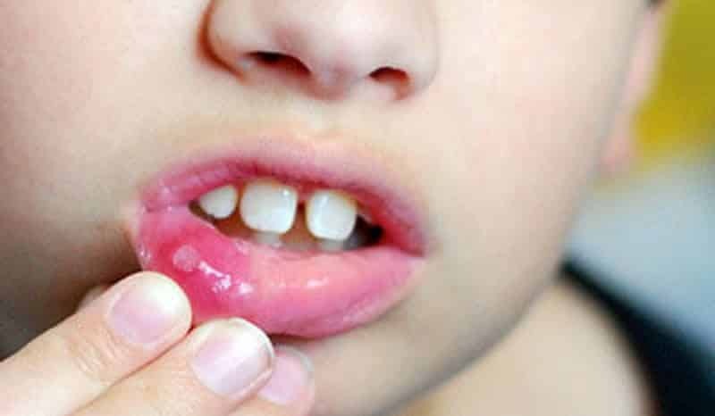 Czy zakaźnego zapalenia jamy ustnej mają dorosłe dzieci lub nie jest zaraźliwy