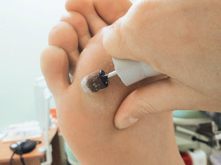How to-treat-dry-calluses-on-legs