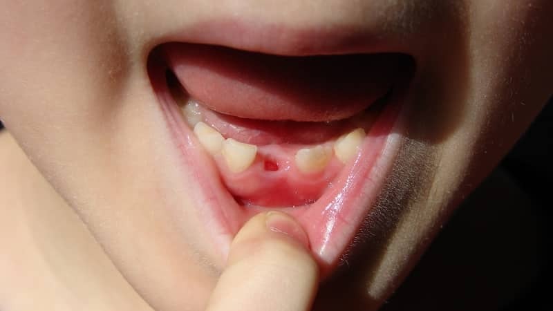 jak wyciągnąć zęba mlecznego dziecko w domu