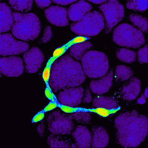 Ontwikkeling van pancreatitis