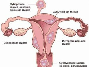 Vrste fibroida maternice