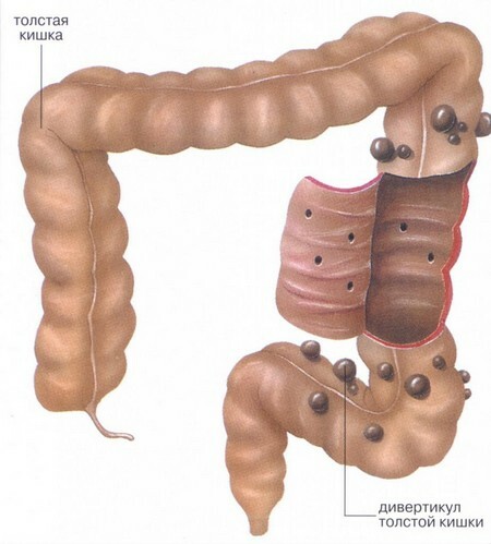 Classification of diverticular disease of the colon