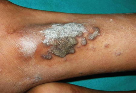 Warty Tuberkulose der Haut