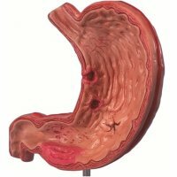 Treatment of gastric ulcer