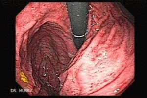 Acute gastritis