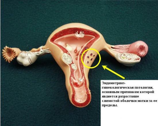 Endometrióza, endometritis a