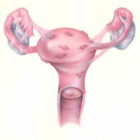 Fitoterapija endometriozės gydyme