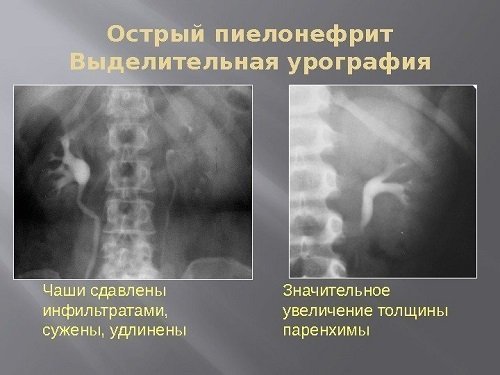 Acute pyelonephritis X-rays