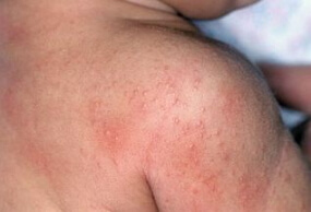 Fotografije s alergijskim simptomima