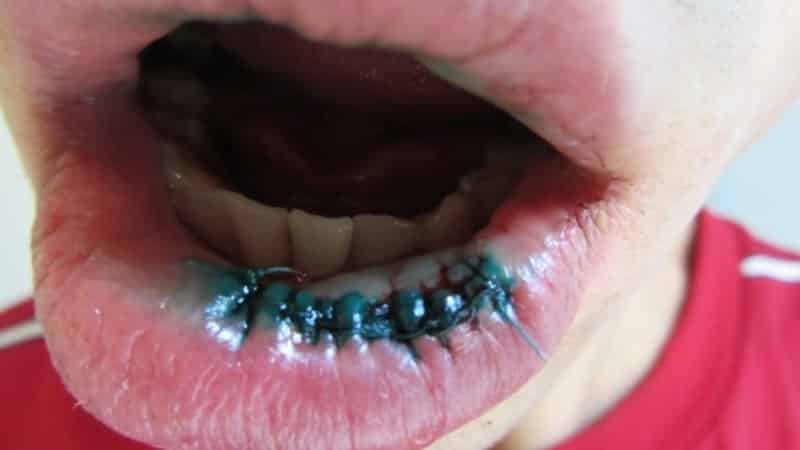 cista usna tretman narodnih lijekova