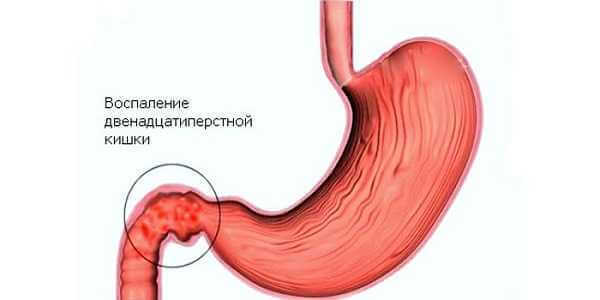 Úlcera duodenal perfurada: sintomas, diagnóstico, tratamento da perfuração