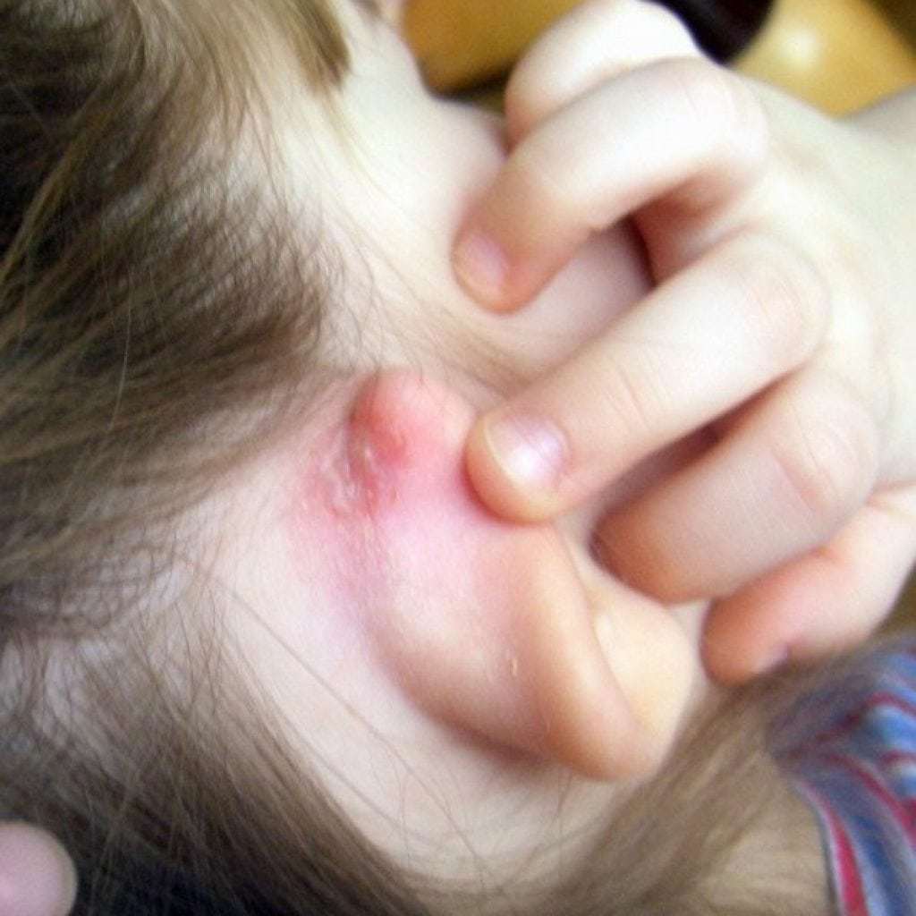 Scrofula: what is this disease, photos in adults and children, symptoms and methods of treatment
