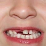 Kako naj rastejo otroške zobe