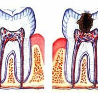 What can lead to deep caries?
