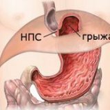 Causes of a hernia of the stomach