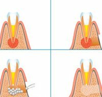 Operation of root tip resection