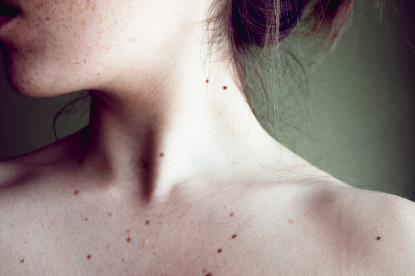 From-what-appear-birthmark-1