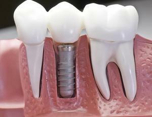 Tannimplantater - de fleste er som ekte tenner og er svært praktisk, ikke forstyrrer andre tenner og ikke dekker dem.