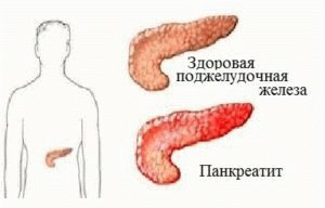 Pancreatitis van de patiënt