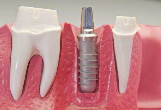 Sådan indsætter tænderne på stifter, hvilke typer af stifter, der anvendes
