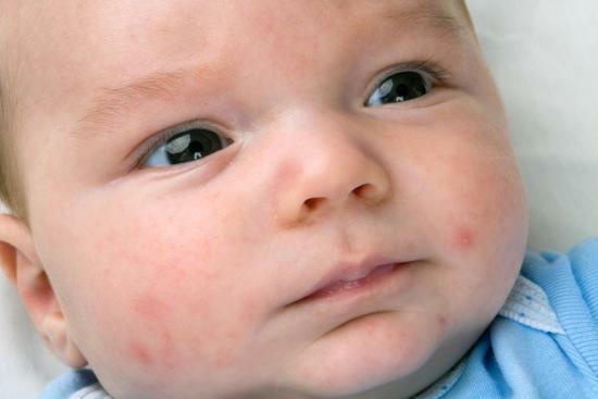 Staphylococcus aureus hos spædbørn, symptomer, behandling, forebyggelse