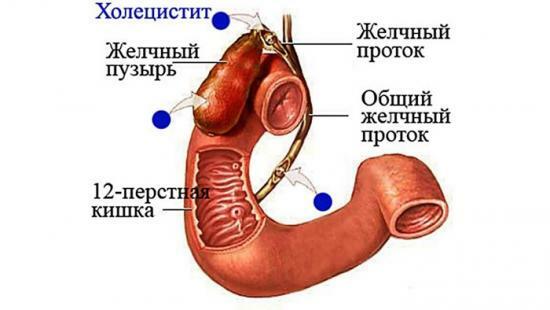 How to treat cholecystitis and pancreatitis, symptoms of how to curb the disease