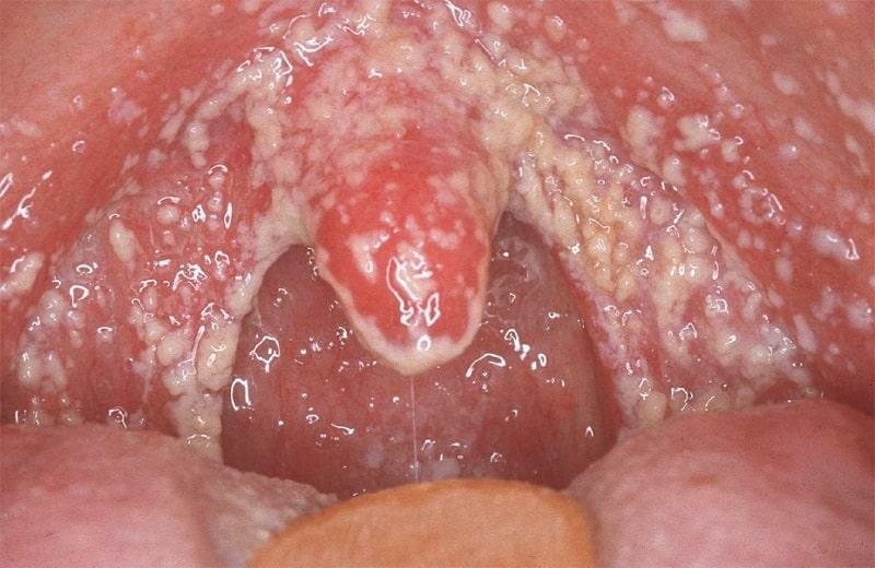 Vita fläckar på tonsiller: foto, behandling