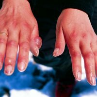 Tratamento da congelação das mãos