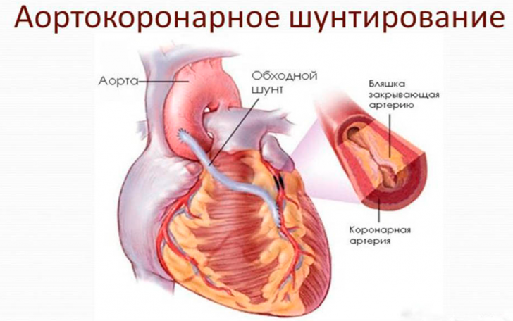 Aorto-coronary bypass surgery