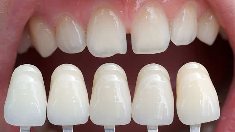 Fest skallfasetter på tennene