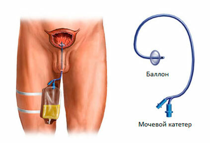 88 urinarni kateter